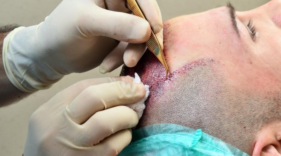 10 معلومات مفصلة حول زراعة الشعر في السعودية